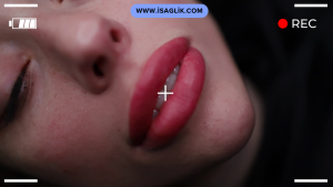 1 cc dudak dolgusu, dudakların hacmini artırmak, kontürlerini belirginleştirmek veya şeklini düzeltmek için en sık tercih edilen miktarlardan biridir. Ancak, dolgunun kalıcılığına etki eden birçok faktör bulunmaktadır.