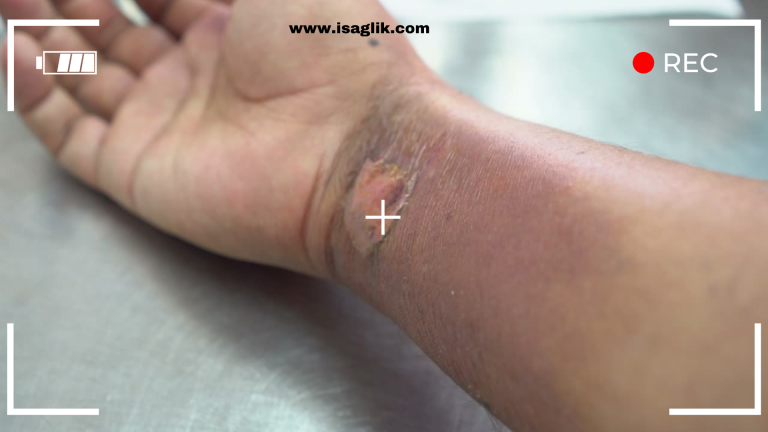 İki derece yanıklar, cildin üst ve orta tabakalarını etkileyen yanıklardır ve genellikle kızarıklık, şişlik, kabarcıklar ve ağrı gibi semptomlarla karakterizedir.