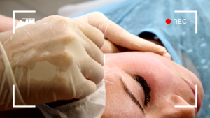 Ameliyatsız yüz germe, cerrahi müdahaleye başvurmadan ciltteki sarkma, kırışıklık ve yaşlanma belirtilerini hafifletmek amacıyla kullanılan bir kozmetik prosedürdür. Bu teknik, genellikle polidiksiyon (PDO) adı verilen biyo-emilimli iplerin kullanılmasıyla gerçekleştirilir.