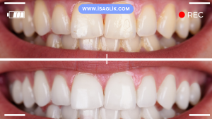 Diş beyazlatma (bleaching) sonrasında, elde edilen beyaz gülümsemenin kalıcı olması ve diş sağlığının korunması için bazı önlemlere dikkat etmek önemlidir.