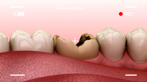 IPS (İnlay, Onlay, Overlay) dolgu yöntemi, diş kaybı yaşanmamış ancak dişte çürük, kırık veya benzeri sorunlar bulunan durumlarda uygulanan bir tedavi yöntemidir.