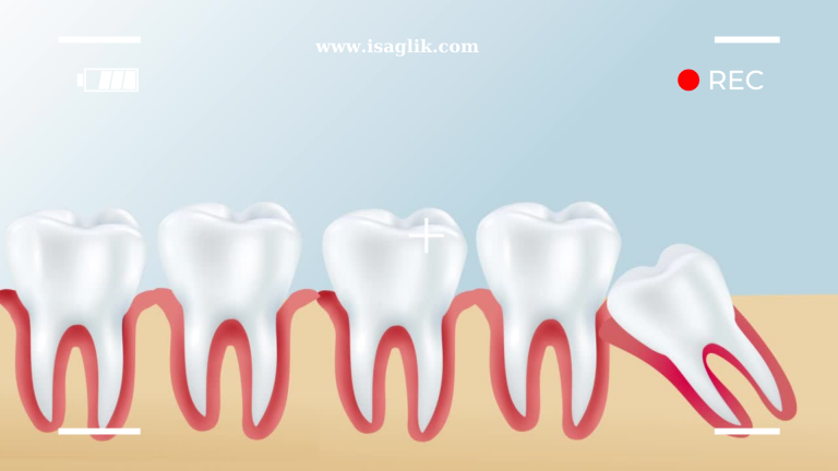 Gömük 20 yaş dişleri, genellikle diş arkasında yer aldıkları için diğer dişler arasında yeterli alan olmadığında sorunlara neden olabilir.