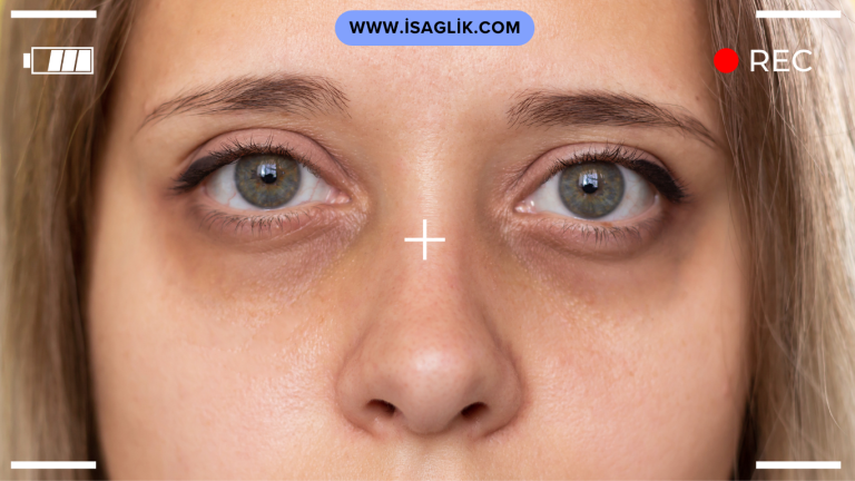 Göz altı morlukları genellikle çeşitli nedenlere bağlı olarak ortaya çıkabilir.