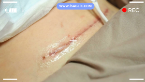 Jinekomasti ameliyatı, bir erkeğin meme dokusunun aşırı büyümesi durumunda yapılan cerrahi bir işlemdir. Devletin jinekomasti ameliyatını karşılama politikası ülkeye ve sağlık sisteminin yapılandırmasına bağlı olarak değişiklik gösterebilir.