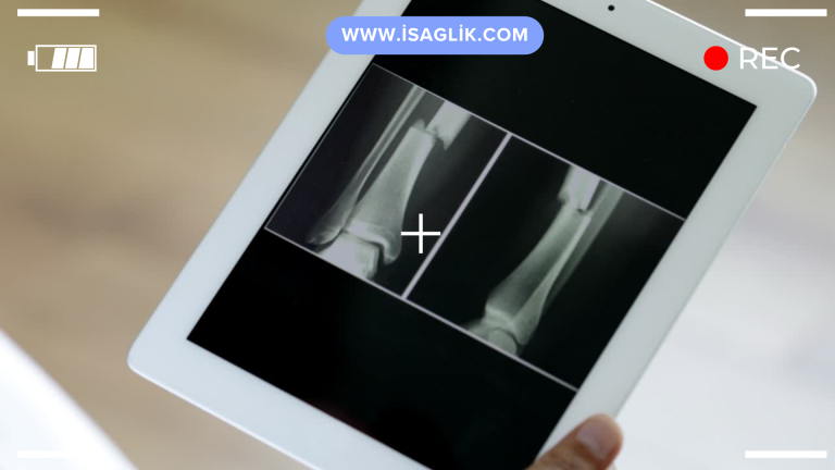 Kırık kemiğin kaynaması, kemiklerin bir araya gelerek tekrar birleşmesi ve iyileşmesi sürecini ifade eder. Bu süreç, kırığın türüne, yerine, kişinin yaşına, genel sağlık durumuna ve tedavi yöntemine bağlı olarak değişiklik gösterebilir.