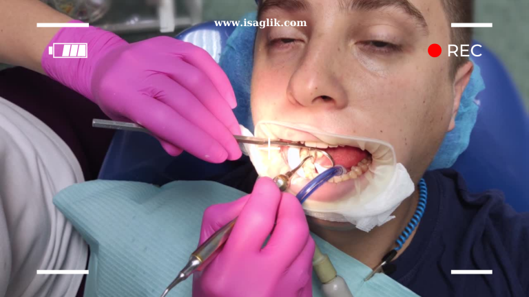 Restoratif diş tedavisi, dişlerin çeşitli nedenlerle zarar görmüş veya kaybolmuş kısımlarını onarmayı amaçlayan bir dental prosedürdür.