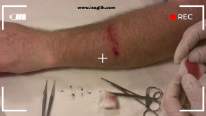 Yara iyileşmesini hızlandırmak için çeşitli yöntemler bulunmaktadır. Bu süreci hızlandırmak için uygun önlemler almak, beslenme düzenine dikkat etmek ve temizlik kurallarına uymak önemlidir.