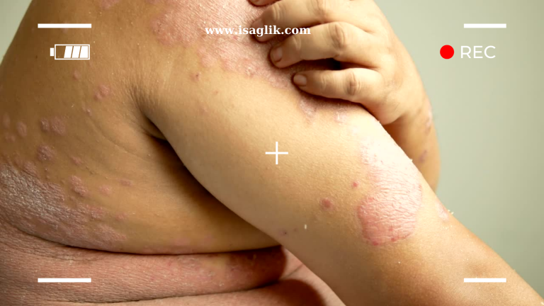 Sedef hastalığı, kronik ve genellikle tekrarlayan bir cilt hastalığıdır. Bu durum, genellikle kızarıklık, pullanma ve kaşıntı ile karakterizedir.