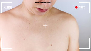 Benlerin alınması genellikle kanser yapmaz. Benler genellikle benign (iyi huylu) tümörlerdir ve çoğu zaman kanserle ilişkilendirilmezler. Ancak, bazı durumlarda benlerin kansere dönüşebileceği nadir durumlar görülebilir.