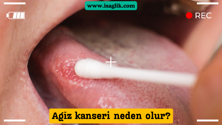 Ağız kanseri, ağız içerisinde veya dudaklarda başlayan ve ağız çevresinde yayılan kanser türlerini ifade eder. Ağız kanseri, genellikle dudaklar, dil, dişetleri, ağız tabanı ve ağız içi mukozası gibi bölgelerde ortaya çıkar.