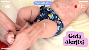 Çocuklarda gıda alerjisi ve aşırı duyarlılık, çocuğun bağışıklık sisteminin belirli gıdalara karşı aşırı tepki vermesi sonucunda ortaya çıkar. Bu durum, çeşitli gıda maddelerine karşı alerjik reaksiyonlar veya intoleranslar şeklinde kendini gösterebilir.