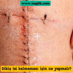 Dikişlerin doğru bir şekilde bakımı ve iyileşmesi, izlerin minimalize edilmesine yardımcı olabilir. Bu makalede, dikiş izlerinin nasıl önlenip tedavi edilebileceği hakkında bilgi verilecek.