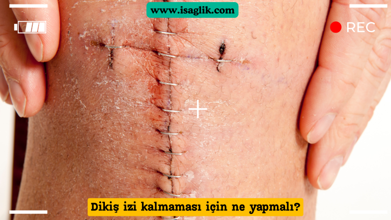 Dikişlerin doğru bir şekilde bakımı ve iyileşmesi, izlerin minimalize edilmesine yardımcı olabilir. Bu makalede, dikiş izlerinin nasıl önlenip tedavi edilebileceği hakkında bilgi verilecek.