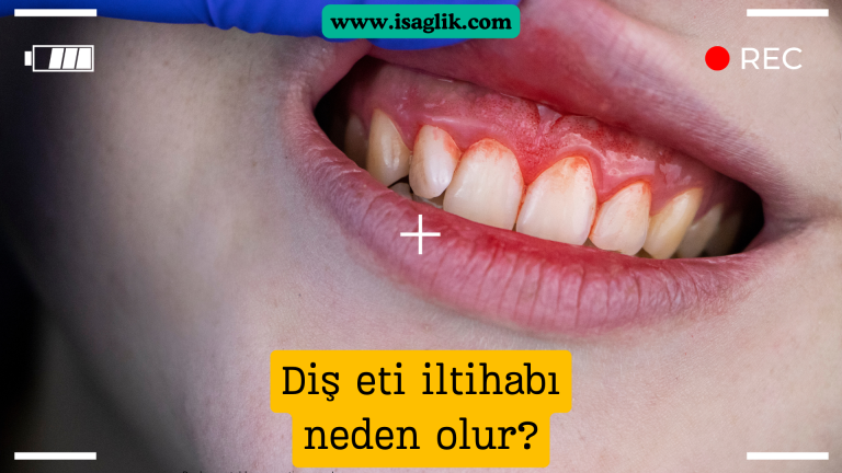 Diş eti iltihabı, diş etlerinin enfekte olması sonucu meydana gelen bir durumdur. Genellikle bakteri plağı birikimi ve diş eti temizliğinin yetersizliği nedeniyle gelişir. Diş eti iltihabı, periodontal hastalığın erken bir aşamasıdır.