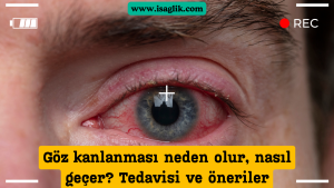 Göz kanlanması neden olur, nasıl geçer Tedavisi ve öneriler