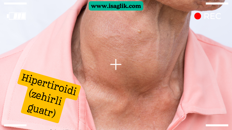 Hipertiroidi, tiroid bezinin aşırı aktif olduğu durumdur. Bu durumda, tiroid bezinin normalden daha fazla tiroid hormonu üretir, vücudun metabolizması hızlanır ve bir dizi semptom ortaya çıkar. Hipertiroidi, Graves hastalığı veya multinodüler toksik guatr gibi tiroid bezinin aşırı stimülasyonu sonucunda meydana gelebilir.