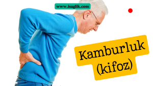 Kifoz, omurganın normalden fazla öne doğru kavis yapması durumudur. Bu durum genellikle omurgadaki kemik deformiteleri, kas zayıflığı, travma, postür bozuklukları, osteoporoz gibi nedenlerden kaynaklanır.