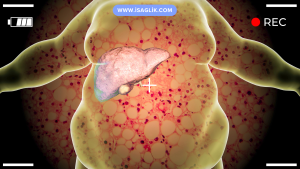Karaciğer yağlanması olan kişilerde, sağlıklı yaşam tarzı değişiklikleri (sağlıklı beslenme, düzenli egzersiz, alkol tüketimini sınırlama) genellikle önerilir. Bununla birlikte, ciddi durumlarda tıbbi tedavi gerekebilir.