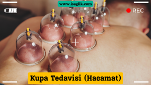 Hacamat, geleneksel bir tedavi yöntemi olarak bilinen bir uygulamadır ve Kupa Tedavisi olarak da adlandırılır. Hacamat, deri altındaki kanı çekmeyi amaçlayan bir tekniktir ve genellikle vakumlu cam veya plastik kaplar kullanılarak yapılır.