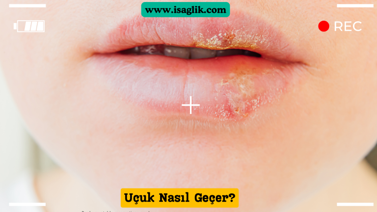 Uçuk, genellikle herpes simpleks virüsü (HSV-1) tarafından neden olan yaygın bir cilt enfeksiyonudur. Genellikle dudaklar, ağız veya burun çevresinde küçük kabarcıklar veya lezyonlar şeklinde görülür.