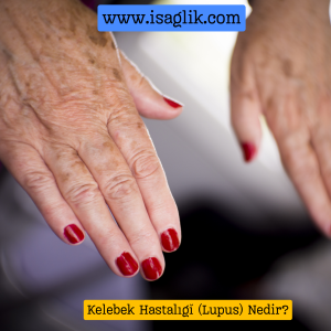 Kelebek hastalığı, bilimsel adıyla lupus, bağışıklık sisteminin vücudu kendi dokularına karşı saldırması sonucu ortaya çıkan otoimmün bir hastalıktır. Lupus, deri, eklemler, böbrekler, beyin ve diğer organları etkileyebilir.